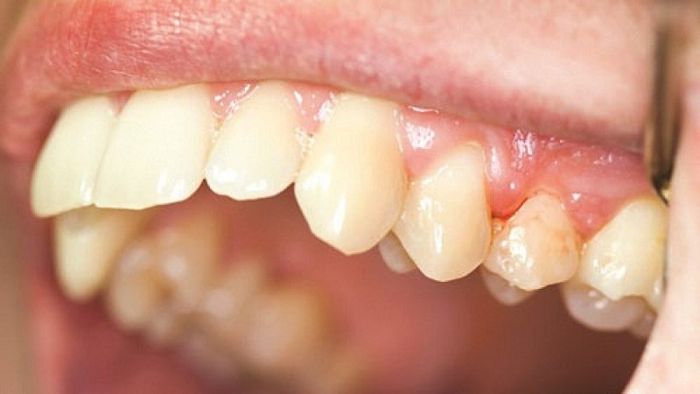 Viêm nha chu là nguyên nhân phổ biến nhất gây ra tình trạng răng lung lay.
