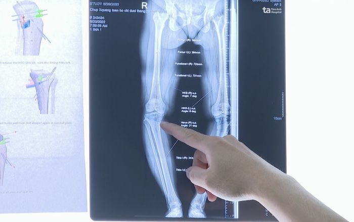Các phương pháp chữa trị cho chân vòng kiềng