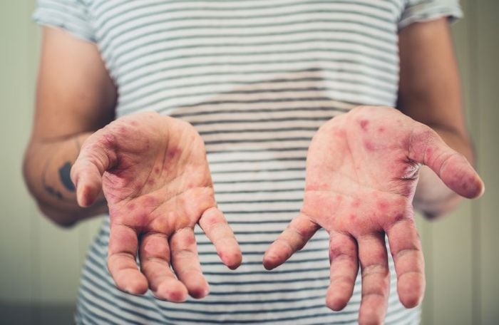 Bệnh tay chân miệng thường gặp ở trẻ em dưới 5 tuổi và dưới 10 tuổi