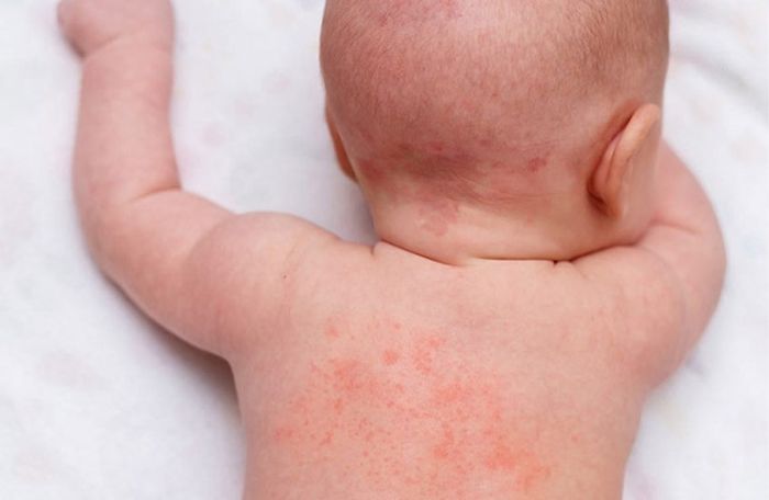 Da của bé sẽ có dấu hiệu nổi mẩn đỏ khi bị dị ứng với nước giặt
