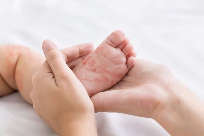 Trẻ bị dị ứng với sữa bò thường phát ban, nổi mẩn đỏ, và cảm giác ngứa rát khó chịu