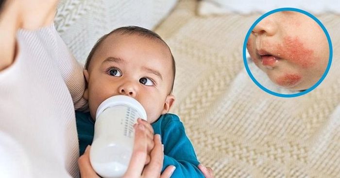 Trẻ bị dị ứng sữa bò là khi cơ thể phản ứng dị ứng khi sử dụng sữa bò và các sản phẩm từ sữa