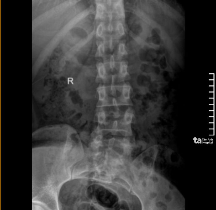 5 bài tập giúp cải thiện tình trạng cong vẹo của cột sống