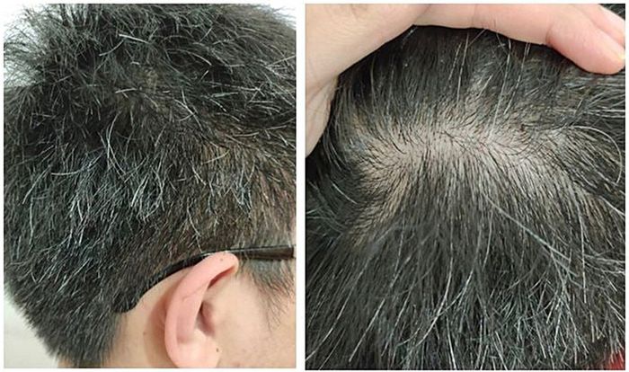 Tóc bạc sớm ở người trẻ: Hình 1.