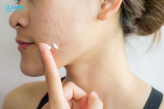 Để thuốc bôi trị mụn có hiệu quả, cần phải dùng đúng cách.