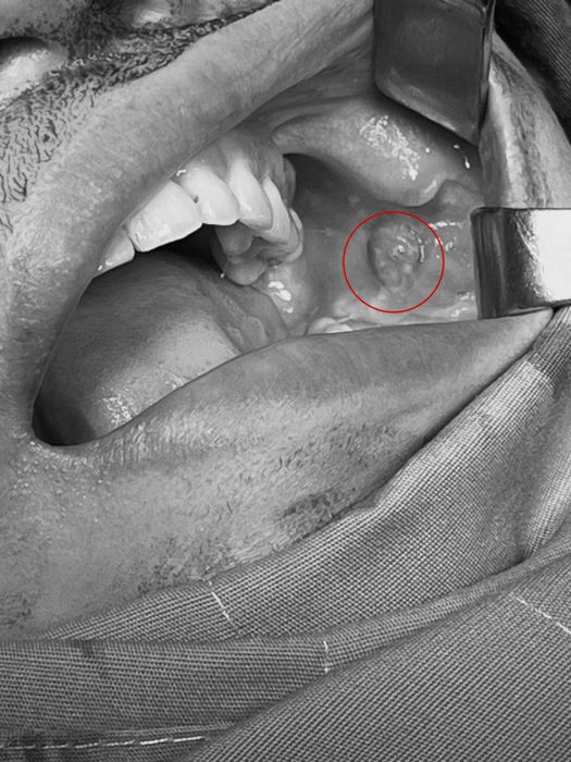 Nữ bệnh nhân gặp nạn sau 5 năm phẫu thuật tạo má lúm đồng tiền- Hình 1.
