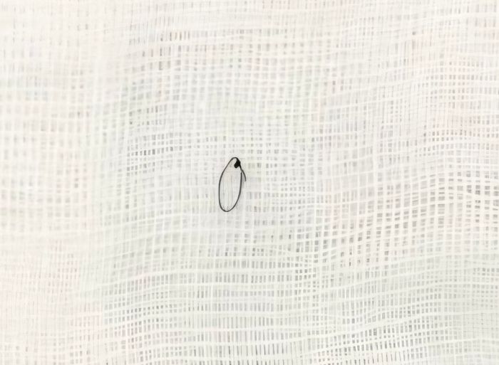 Người phụ nữ gặp nạn sau 5 năm từ khi phẫu thuật tạo má lúm đồng tiền - Hình ảnh 2.