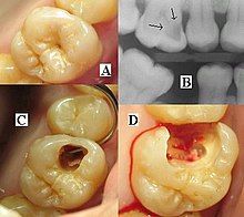Ba hình ảnh của một trường hợp suy thoái răng + một hình ảnh chụp X-quang.