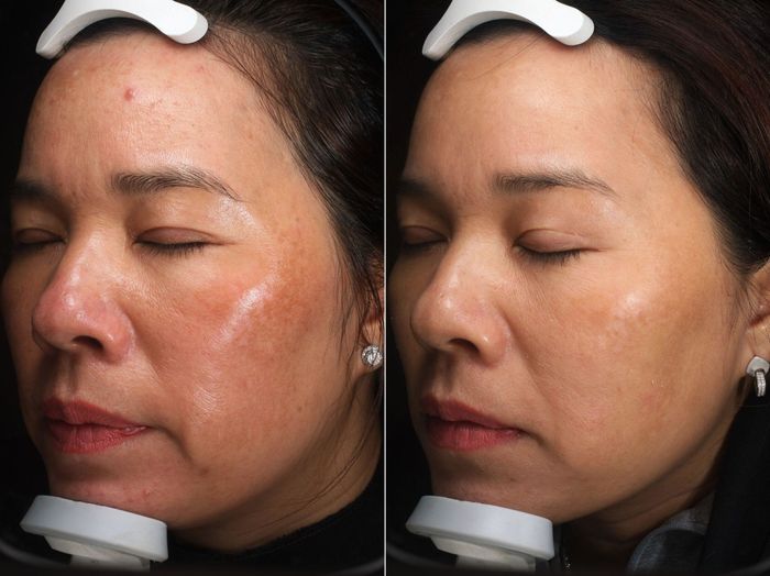 Thông tin cần thiết về nám ở vùng má