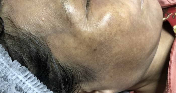 Những điều cần biết về nám vùng má