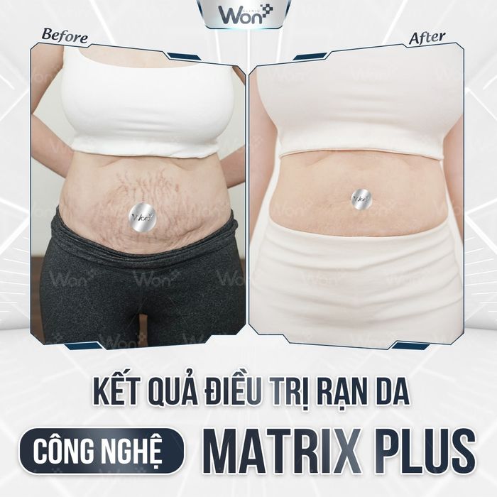 Công nghệ điều trị rạn da Matrix Plus