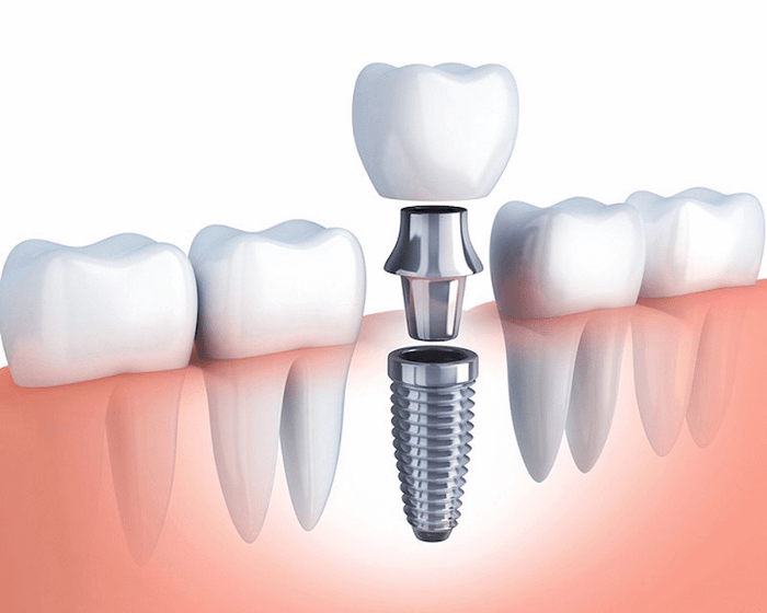 trồng răng implant