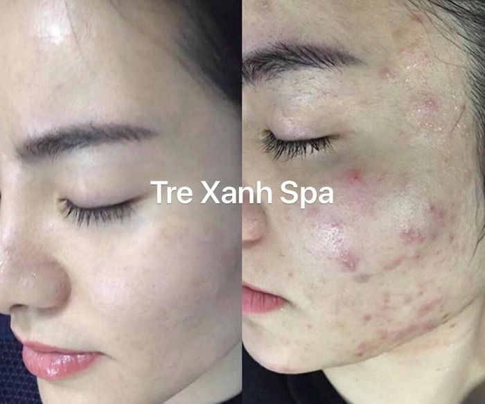 Tre Xanh Spa hình ảnh 2