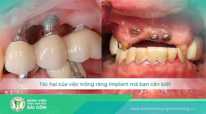 những rủi ro của việc cấy ghép răng implant