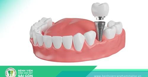 những rủi ro khi cấy ghép răng implant