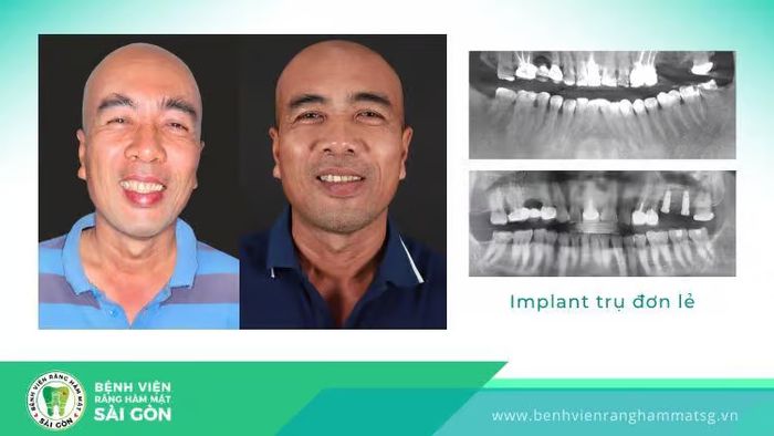 rủi ro của việc cấy ghép răng implant