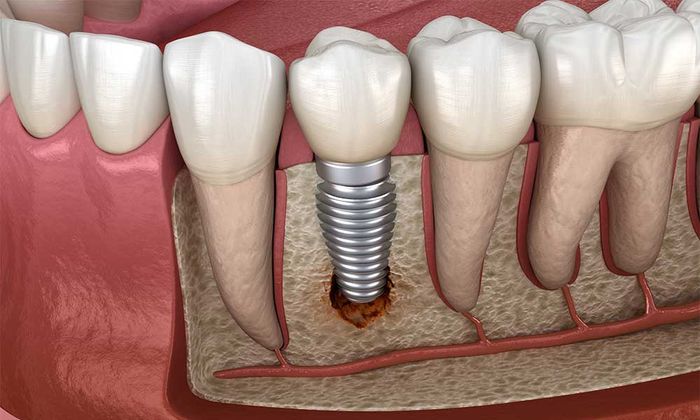 Nhiễm trùng tại khu vực cấy ghép