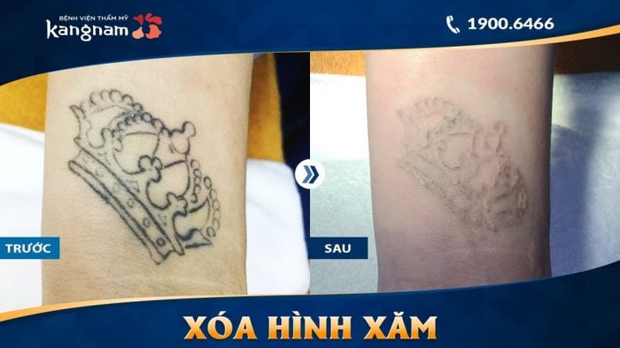 xóa xăm tại hà nội