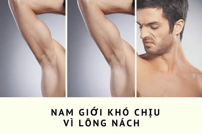 Triệt lông cho nam giới tại Hà Nội