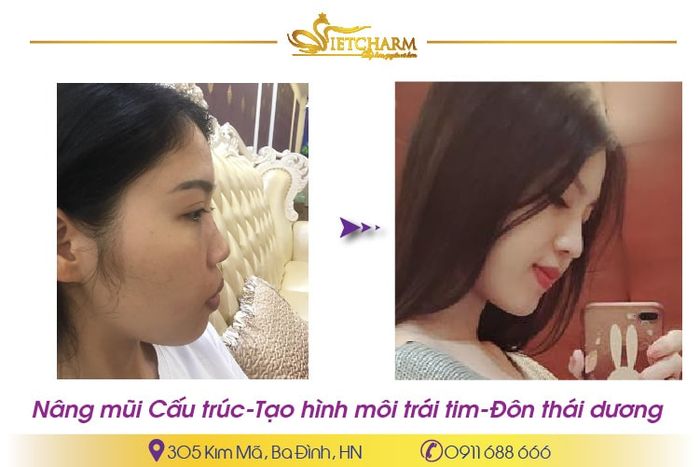 Nâng mũi tại Hà Nội - Vietcharm