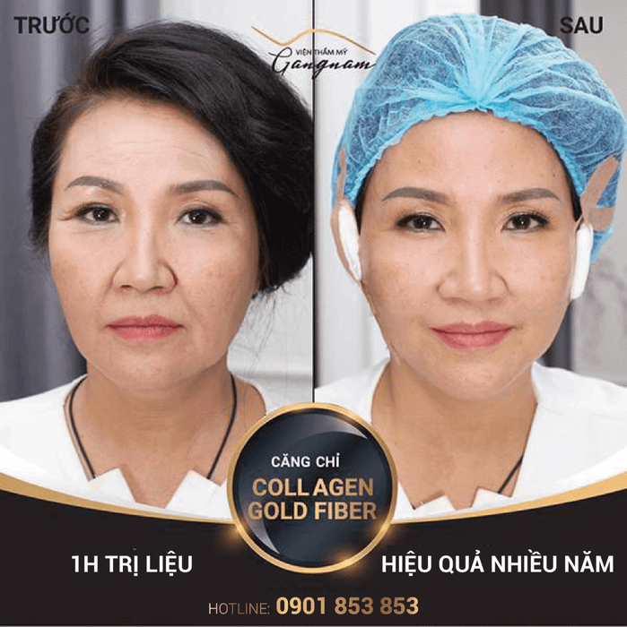 Căng da mặt bằng chỉ collagen