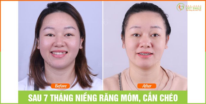 Hình ảnh Nha Khoa VIET SMILE 1