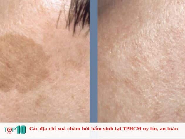 Các địa chỉ xóa chàm bớt bẩm sinh tại TPHCM uy tín và an toàn