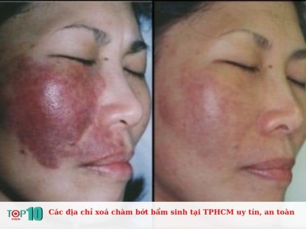 Các địa chỉ xoá chàm bớt bẩm sinh tại TPHCM uy tín, an toàn