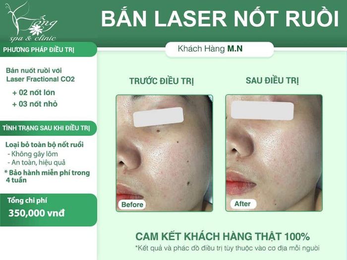 tẩy nốt ruồi bằng laser mất bao lâu để hồi phục