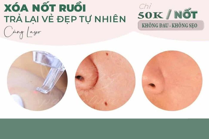 tẩy nốt ruồi bằng laser mất bao lâu để hồi phục