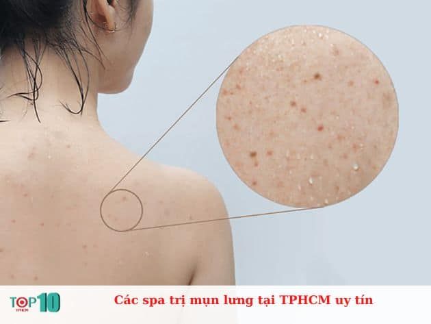 Danh sách các spa trị mụn lưng uy tín tại TP.HCM