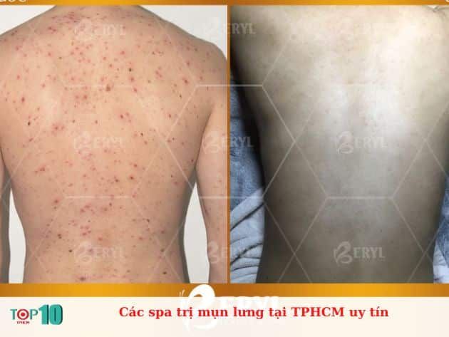 Những spa uy tín điều trị mụn lưng tại TPHCM