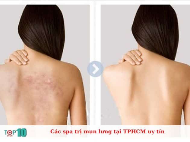 Các spa uy tín chuyên trị mụn lưng tại TPHCM