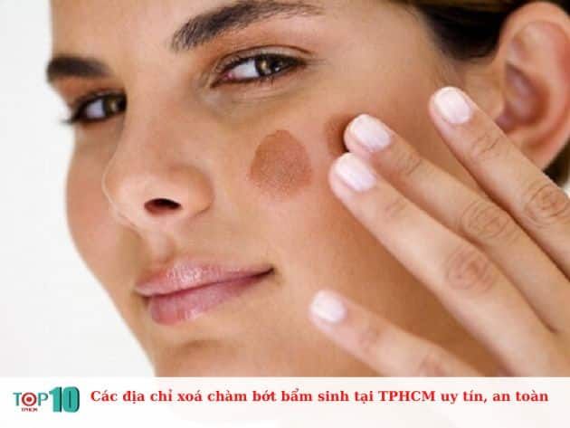 Danh sách các địa chỉ uy tín và an toàn để xóa chàm bớt bẩm sinh tại TPHCM