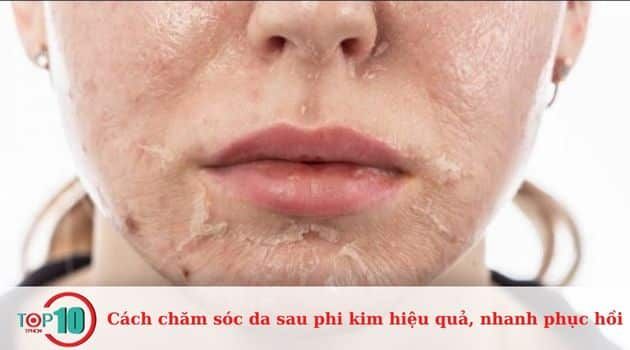 Hướng dẫn chăm sóc da sau phi kim từ ngày thứ 4 đến ngày thứ 6