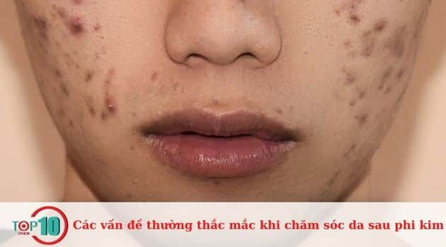 Da bị thâm sau khi phun kim thì phải làm thế nào?