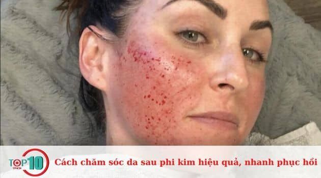 Hướng dẫn chăm sóc da sau khi kim trong ba ngày đầu tiên.