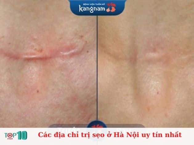 Những địa chỉ điều trị sẹo uy tín nhất tại Hà Nội