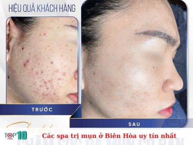 Danh sách các spa trị mụn uy tín tại Biên Hòa