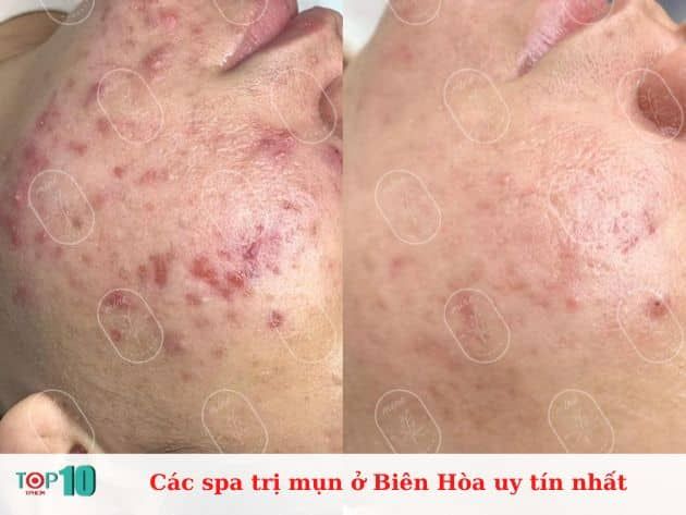 Những Spa Trị Mụn Uy Tín Tại Biên Hòa