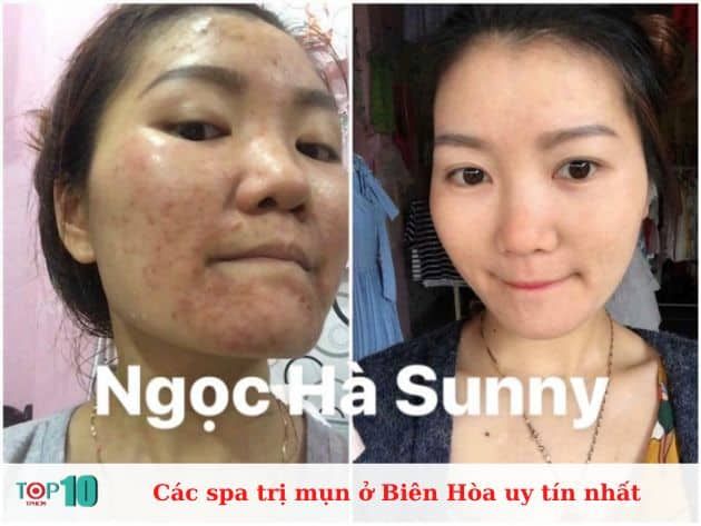 Những spa trị mụn uy tín nhất ở Biên Hòa