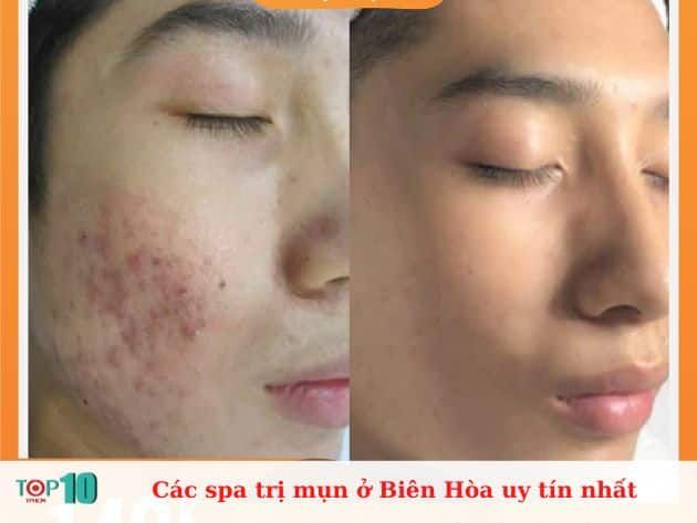 Những Spa Trị Mụn Uy Tín Tại Biên Hòa