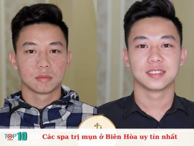 Các spa trị mụn uy tín nhất tại Biên Hòa