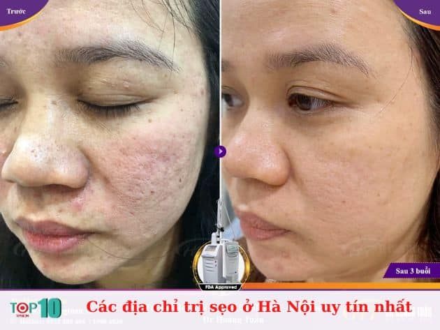 Các địa chỉ điều trị sẹo uy tín nhất tại Hà Nội