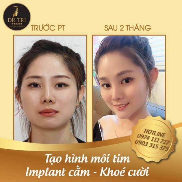 Cắt môi trái tim ở đâu uy tín và đẹp tại TPHCM - Tiến Sĩ Bác Sĩ Đỗ Thành Trí | Nguồn: Tiến Sĩ Bác Sĩ Đỗ Thành Trí