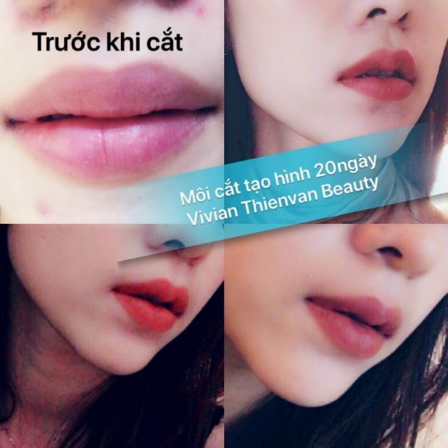 Cắt môi trái tim đẹp và uy tín tại TP.HCM - Vivian ThienVan Beauty | Nguồn: Vivian ThienVan Beauty