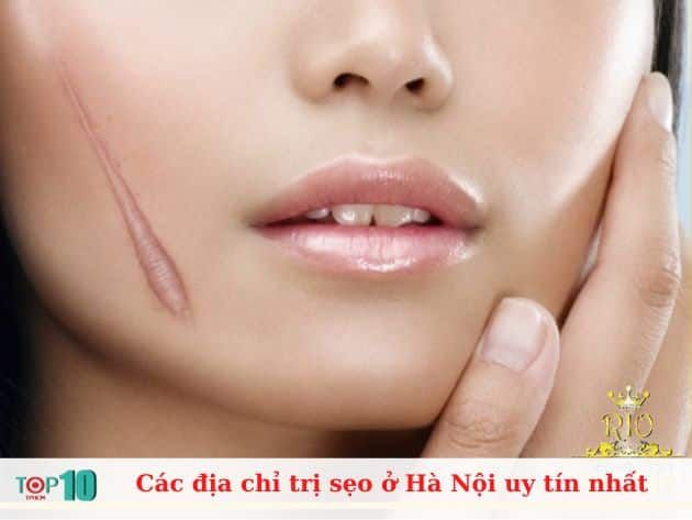 Các địa chỉ trị sẹo uy tín nhất tại Hà Nội