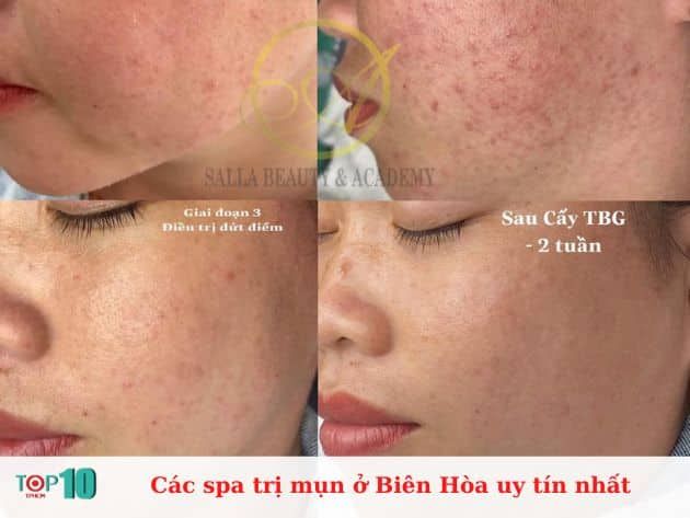 Danh sách các spa trị mụn uy tín tại Biên Hòa