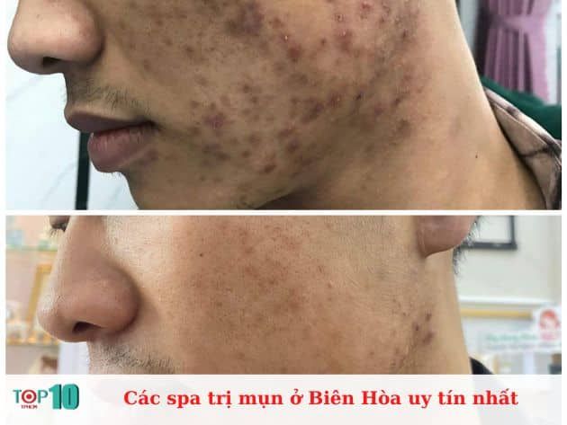 Danh sách các spa trị mụn uy tín tại Biên Hòa