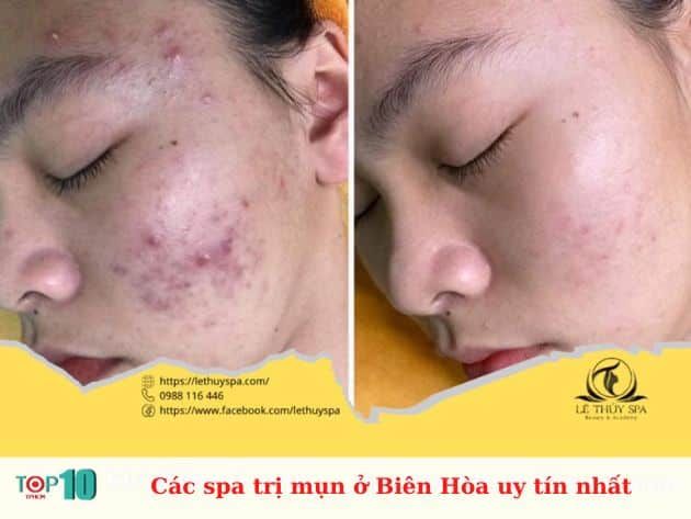 Danh sách các spa trị mụn uy tín tại Biên Hòa